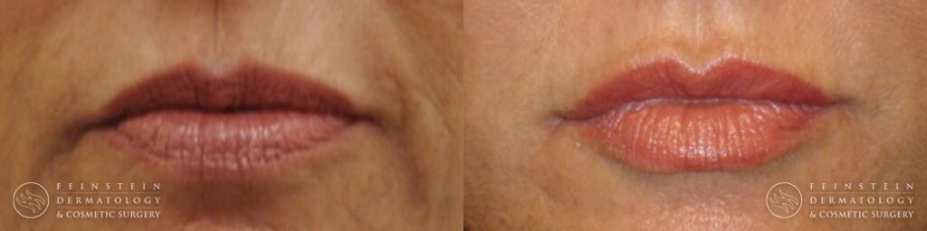 58 year old female dermal filler to marionette lips nasiolabal folds