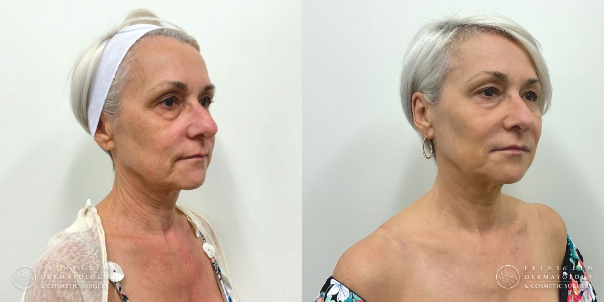 Laser Skin Treatments