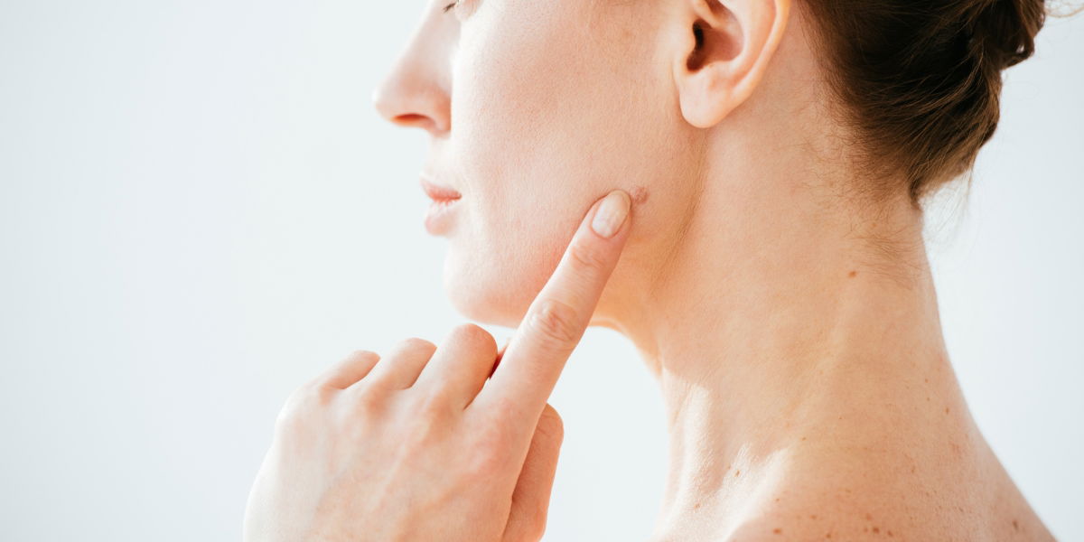 Model Pointing to Mole on Face