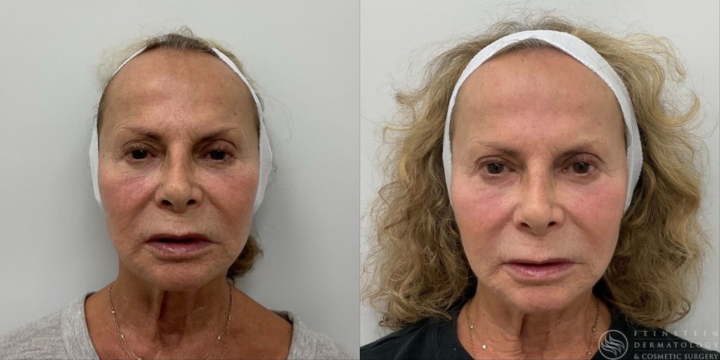 Forever Young BBL bef15499 eb02 4e98 8c08 5e728a21093b | Feinstein Dermatology Forever Young BBL bef15499 eb02 4e98 8c08 5e728a21093b
