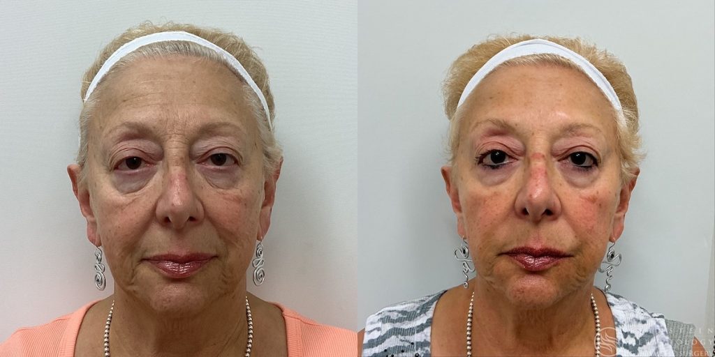 Botox CosmeticDysportJeuveau   edab2ce2 2f26 43f7 bcaa 13f0e64f7537