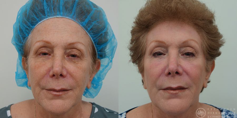 Laser Skin Resurfacing   4a1dc0e5 197a 4377 8e92 2d3bc6ac66d6